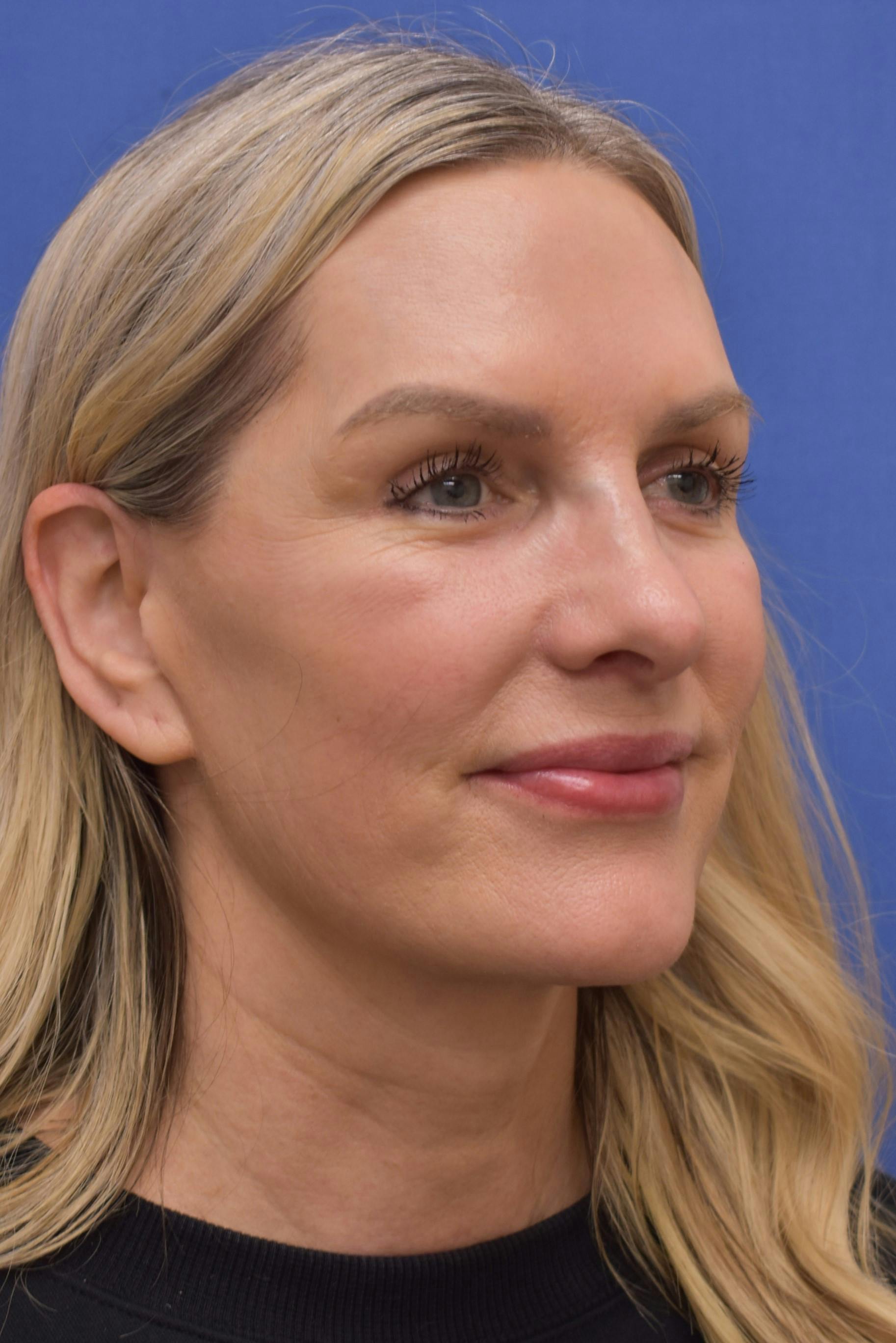 facelift