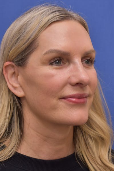 Necklift Before & After Gallery - Patient 406242 - Image 2