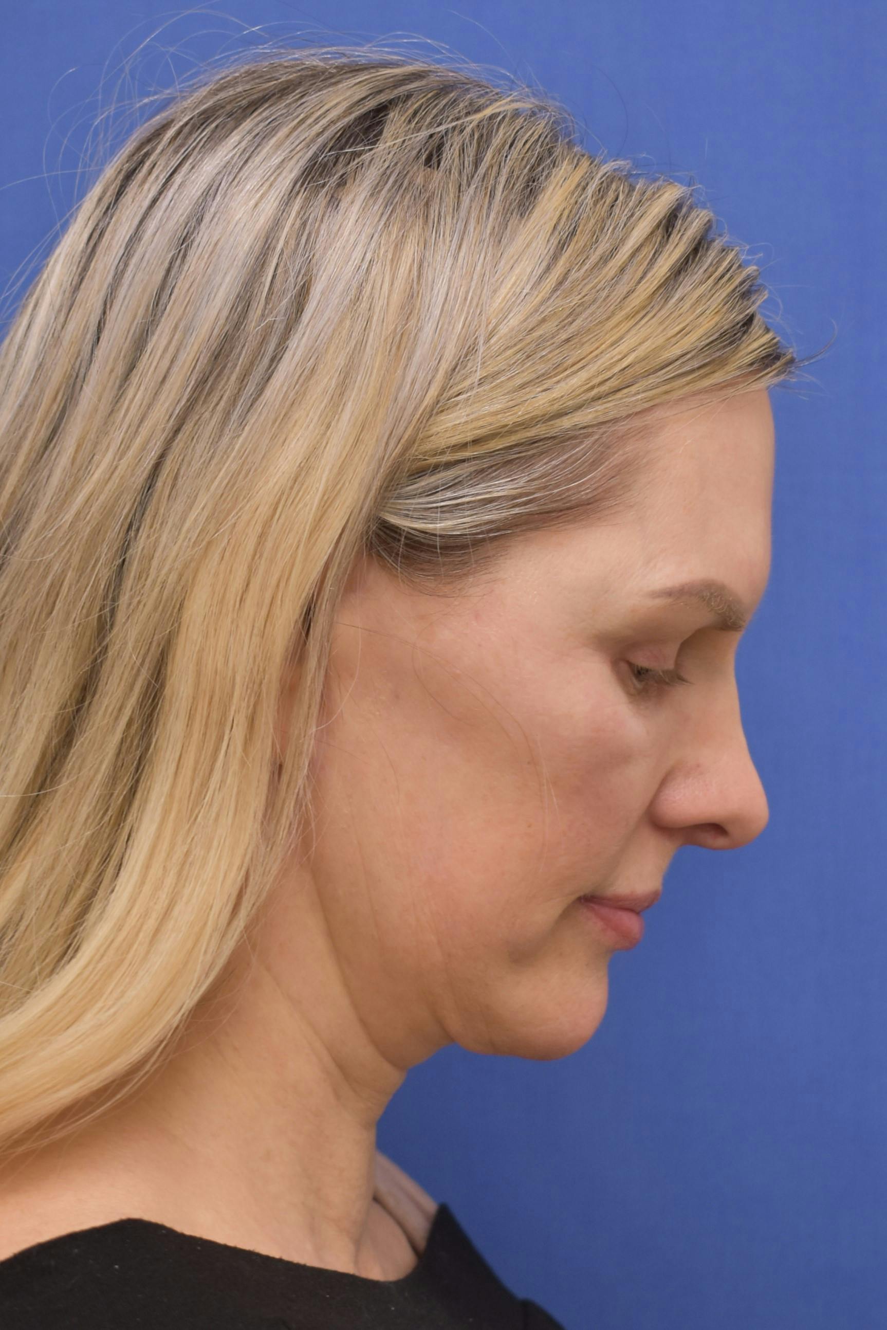 facelift