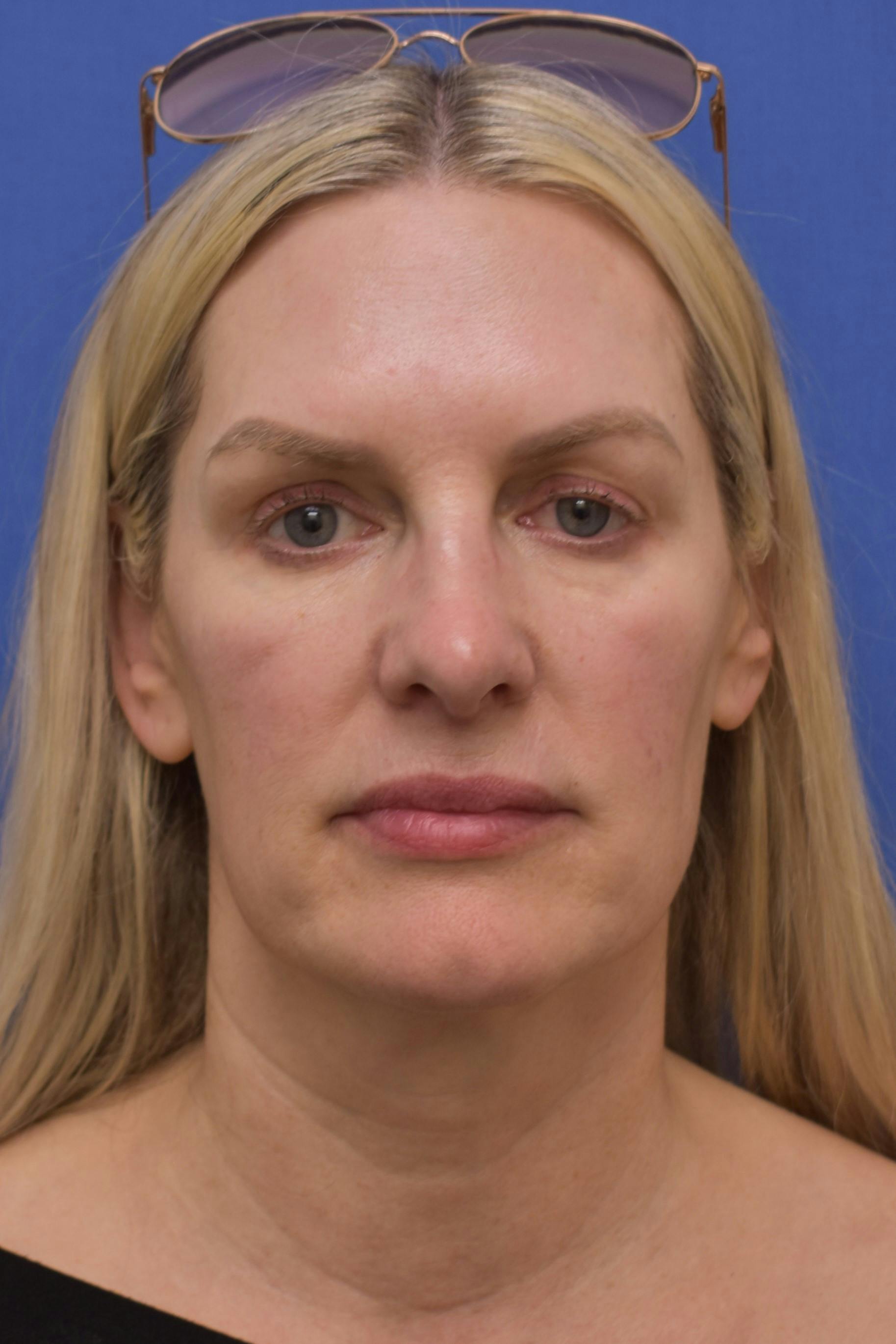 facelift