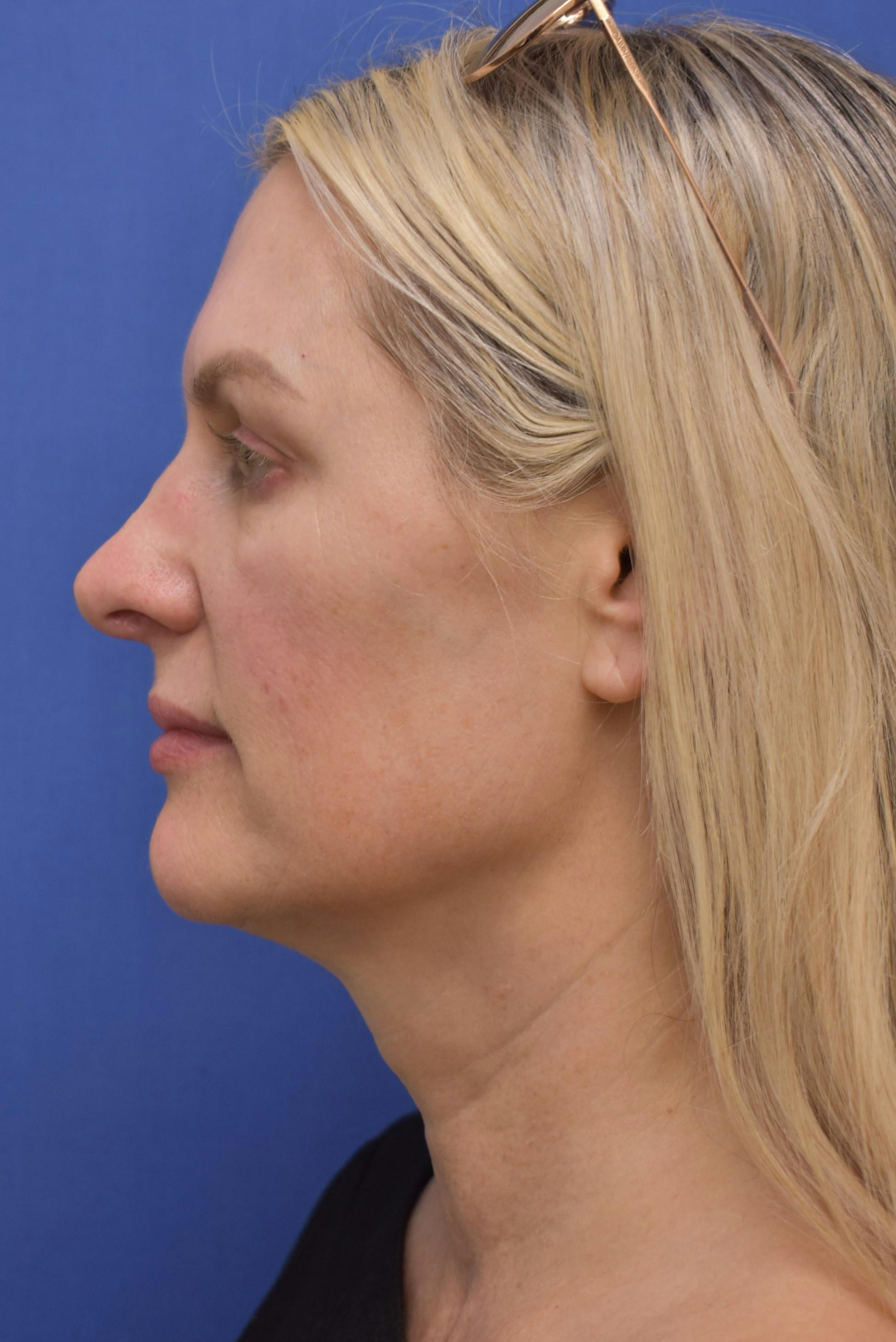 facelift