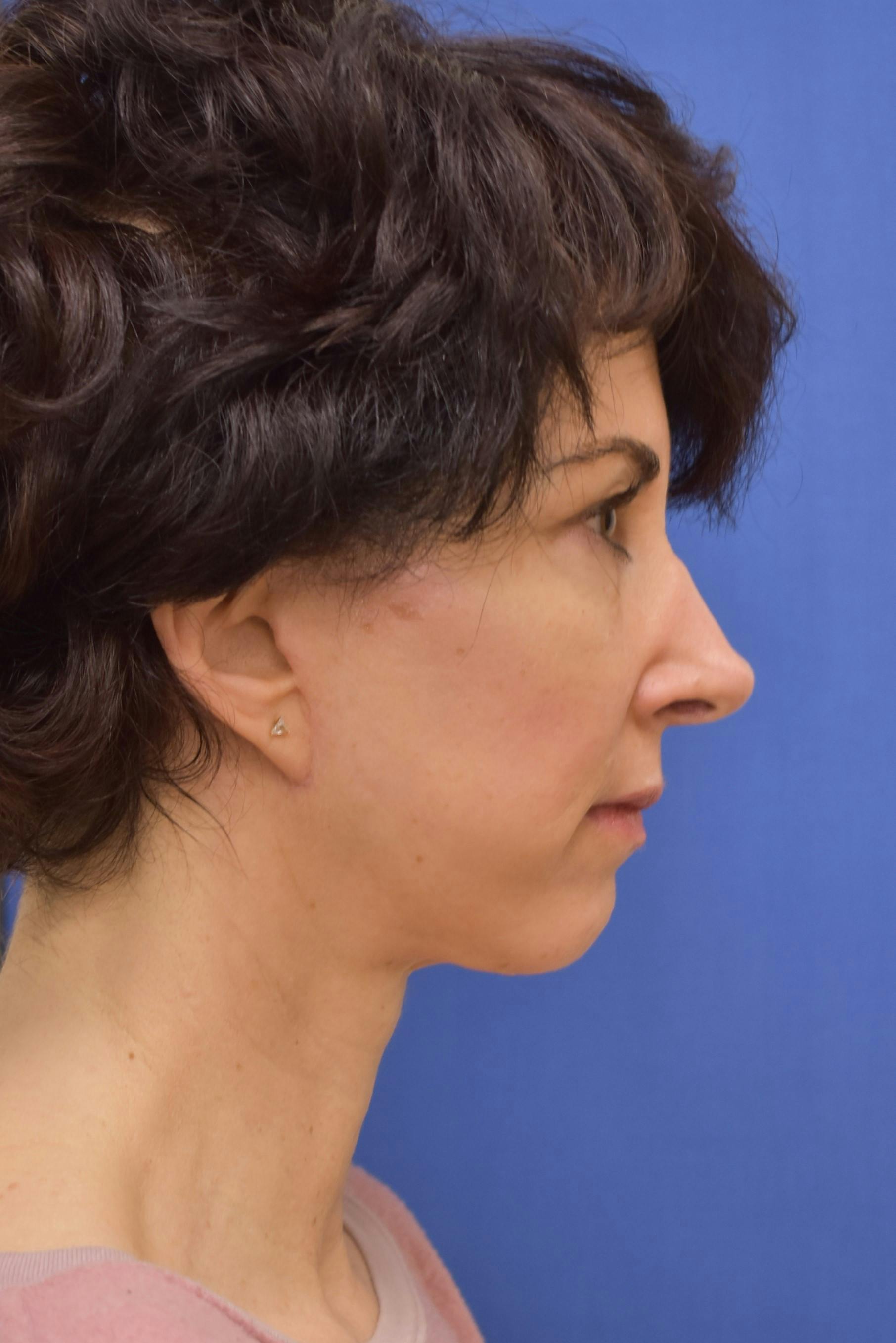 facelift