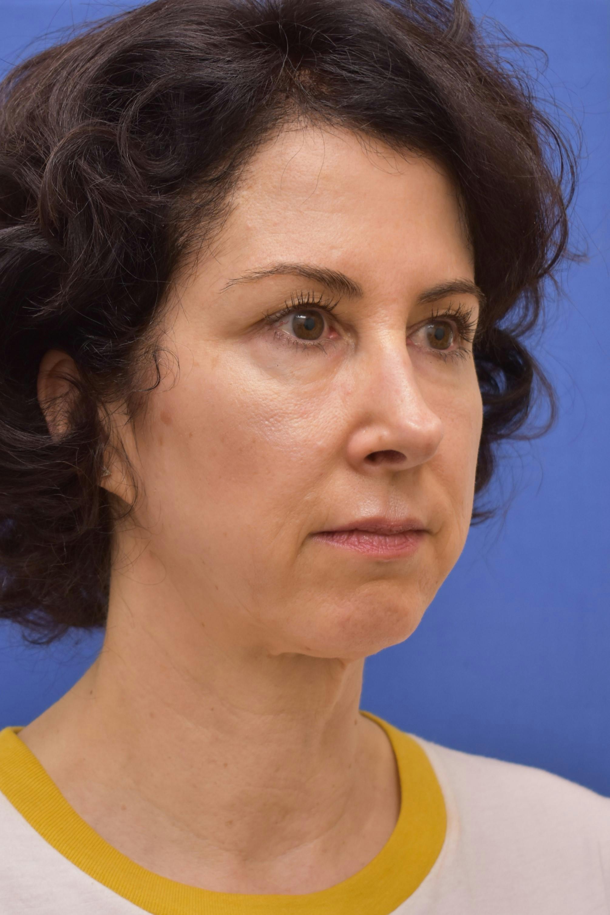 facelift