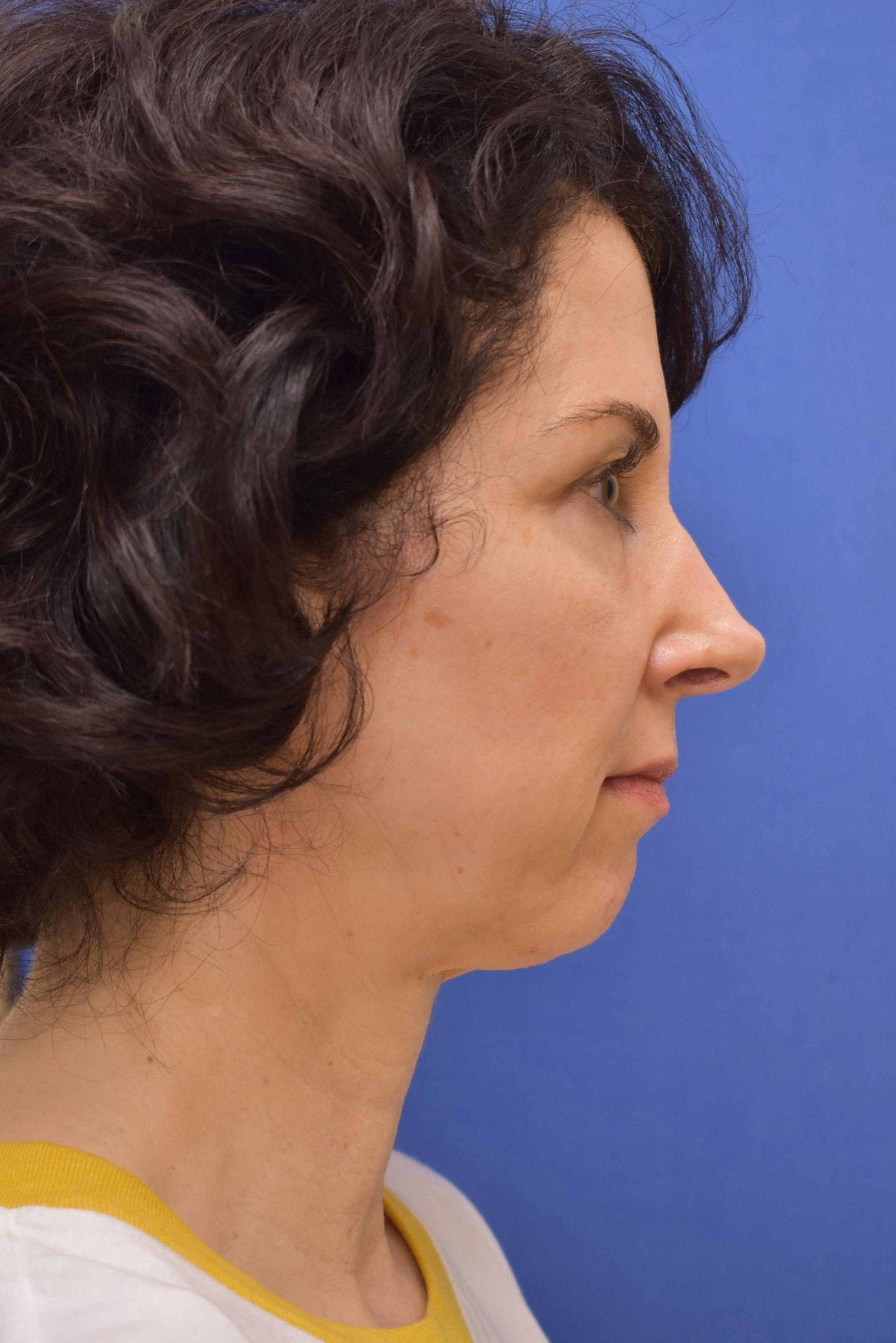 facelift
