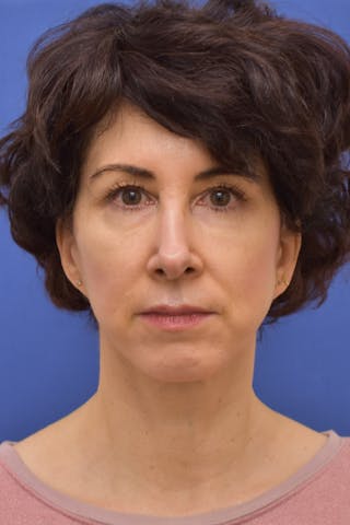 Necklift Before & After Gallery - Patient 627732 - Image 2