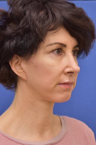 Necklift Before & After Gallery - Patient 627732 - Image 6