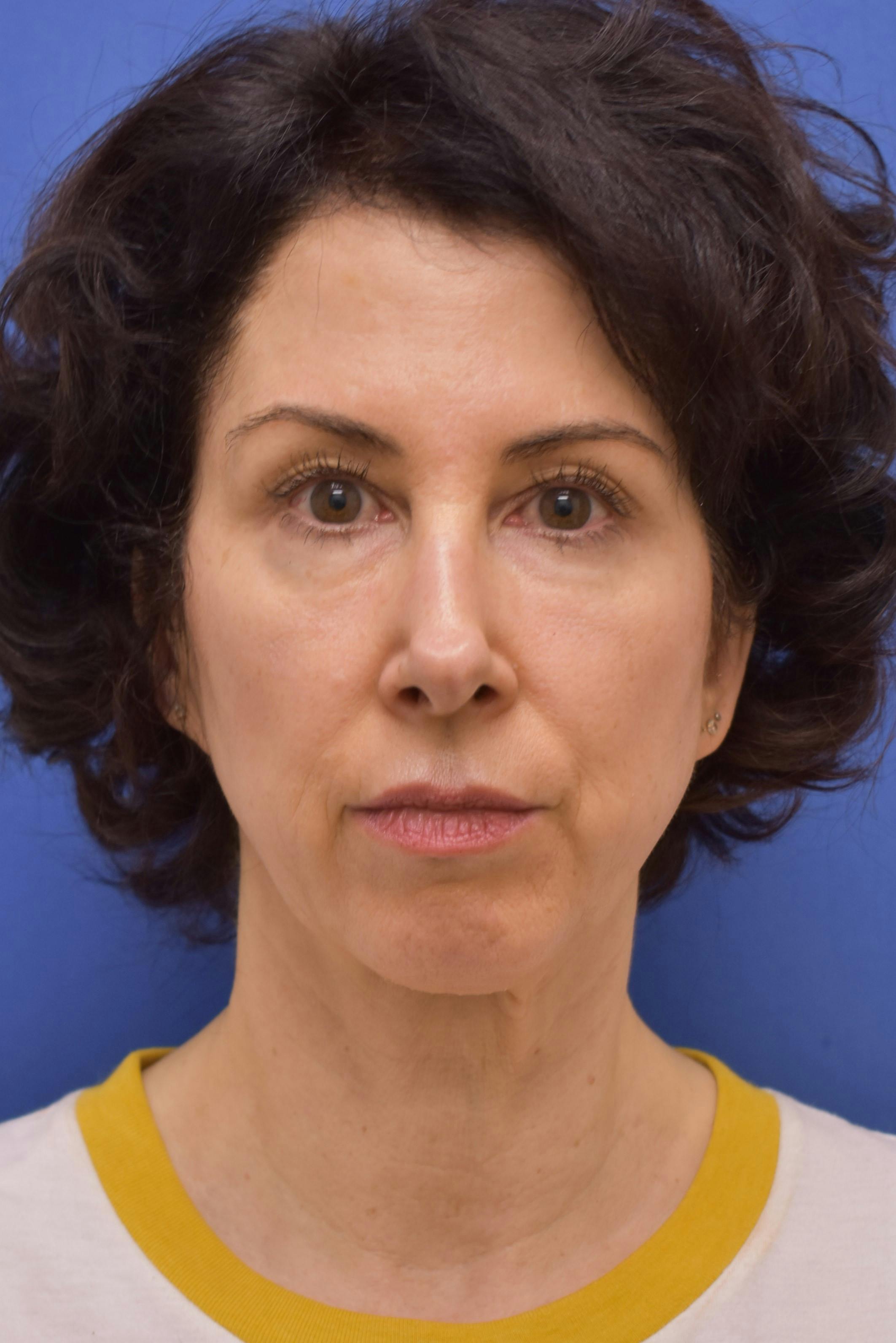 facelift