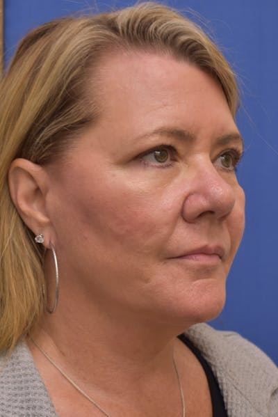 Necklift Before & After Gallery - Patient 278009 - Image 2