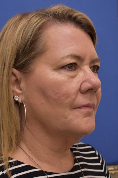 Facelift Before & After Gallery - Patient 192352 - Image 1