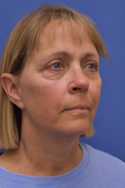 Necklift Before & After Gallery - Patient 253936 - Image 2
