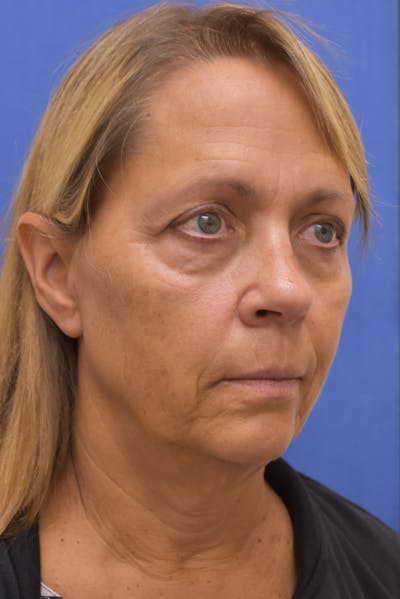 Facelift Before & After Gallery - Patient 246340 - Image 1