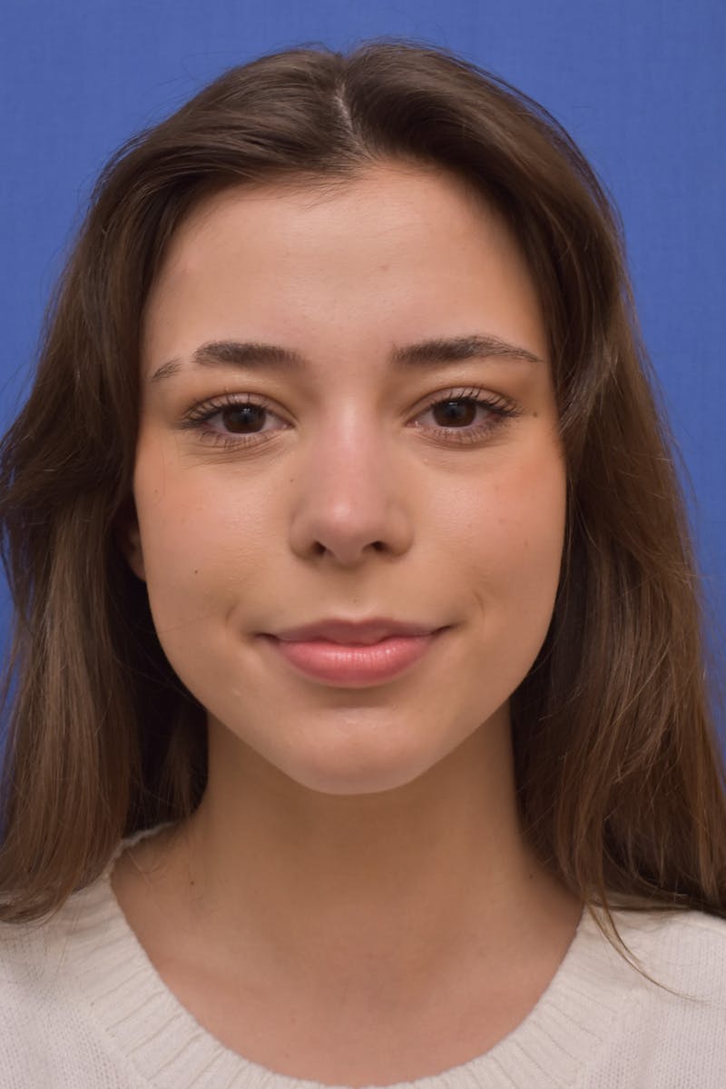 Rhinoplasty Before & After Gallery - Patient 244525 - Image 4