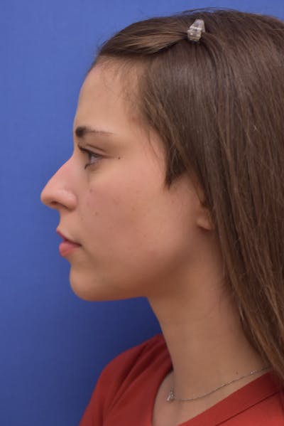 Rhinoplasty Before & After Gallery - Patient 244525 - Image 1