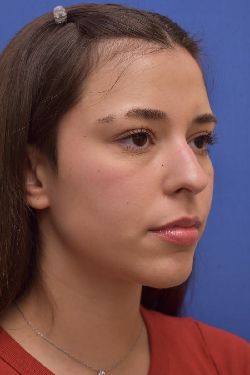 Rhinoplasty Before & After Gallery - Patient 244525 - Image 5