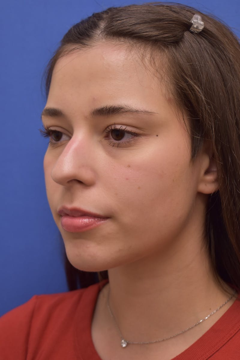 Rhinoplasty Before & After Gallery - Patient 244525 - Image 7