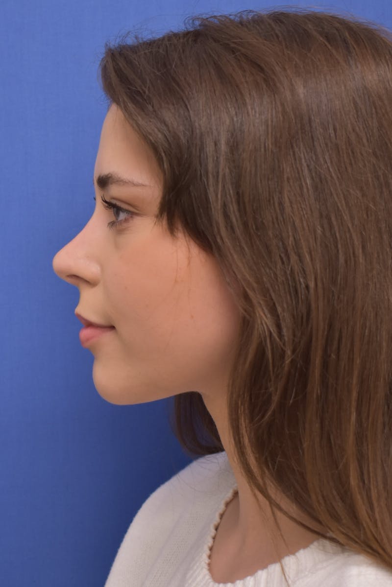 Rhinoplasty Before & After Gallery - Patient 244525 - Image 2