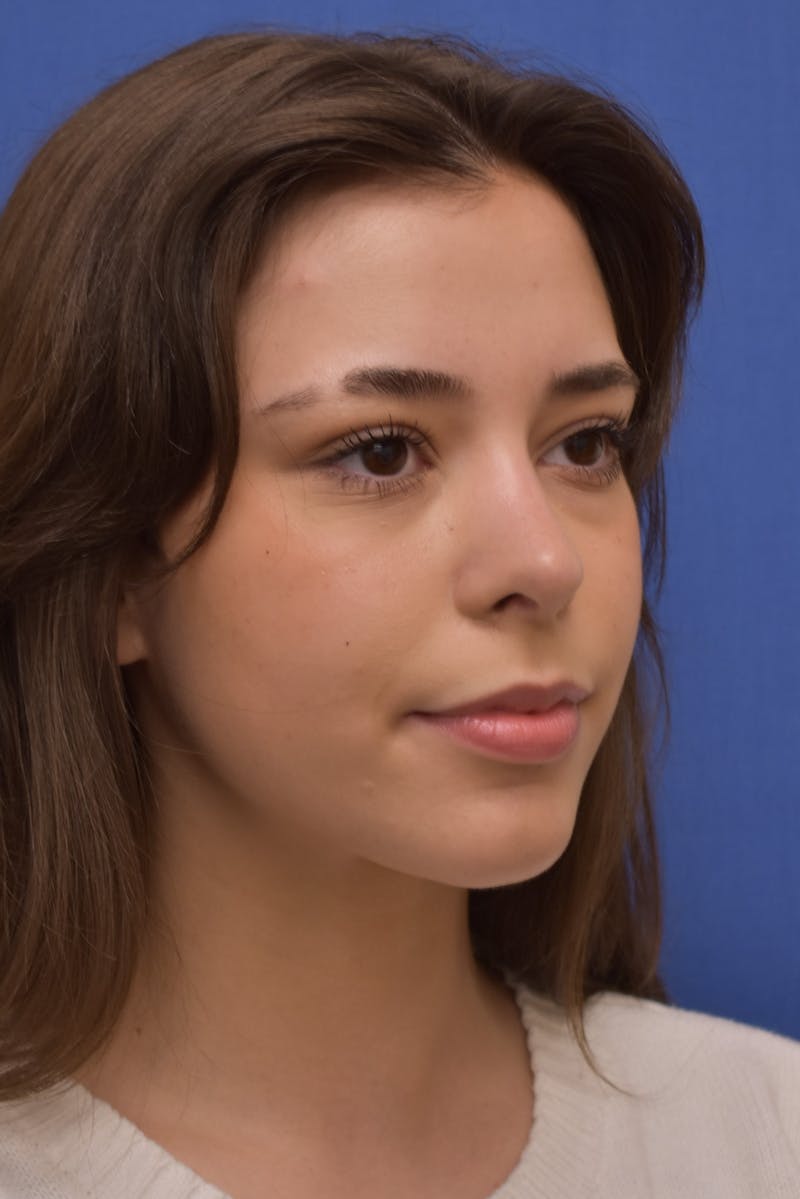 Rhinoplasty Before & After Gallery - Patient 244525 - Image 6