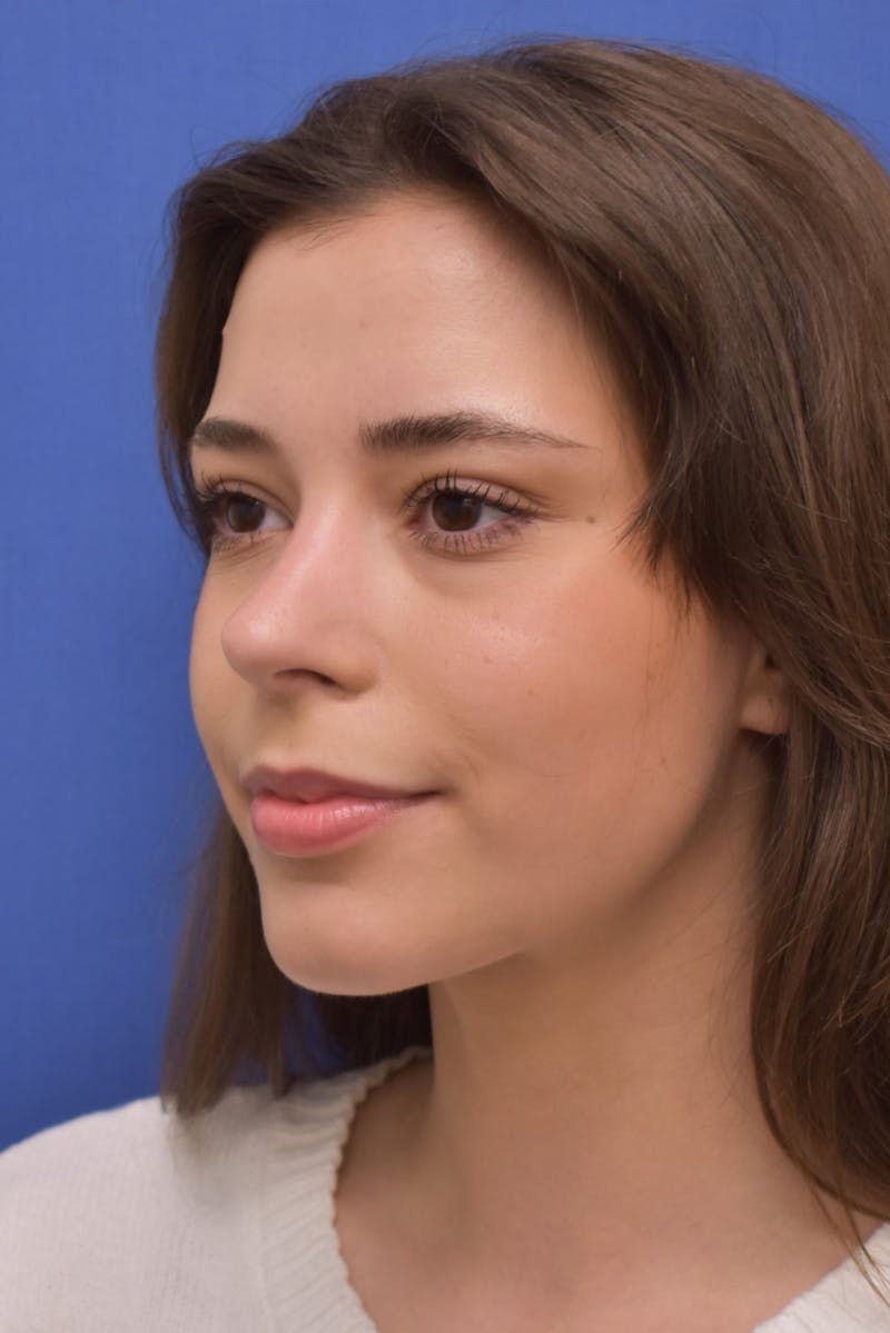 Rhinoplasty Before & After Gallery - Patient 244525 - Image 8