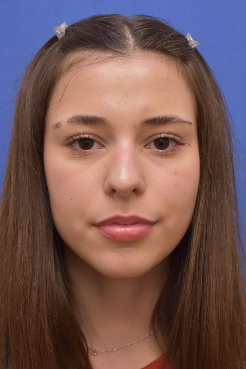 Rhinoplasty Before & After Gallery - Patient 244525 - Image 3