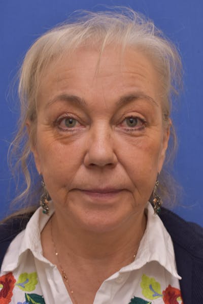 Facelift Before & After Gallery - Patient 218514 - Image 2