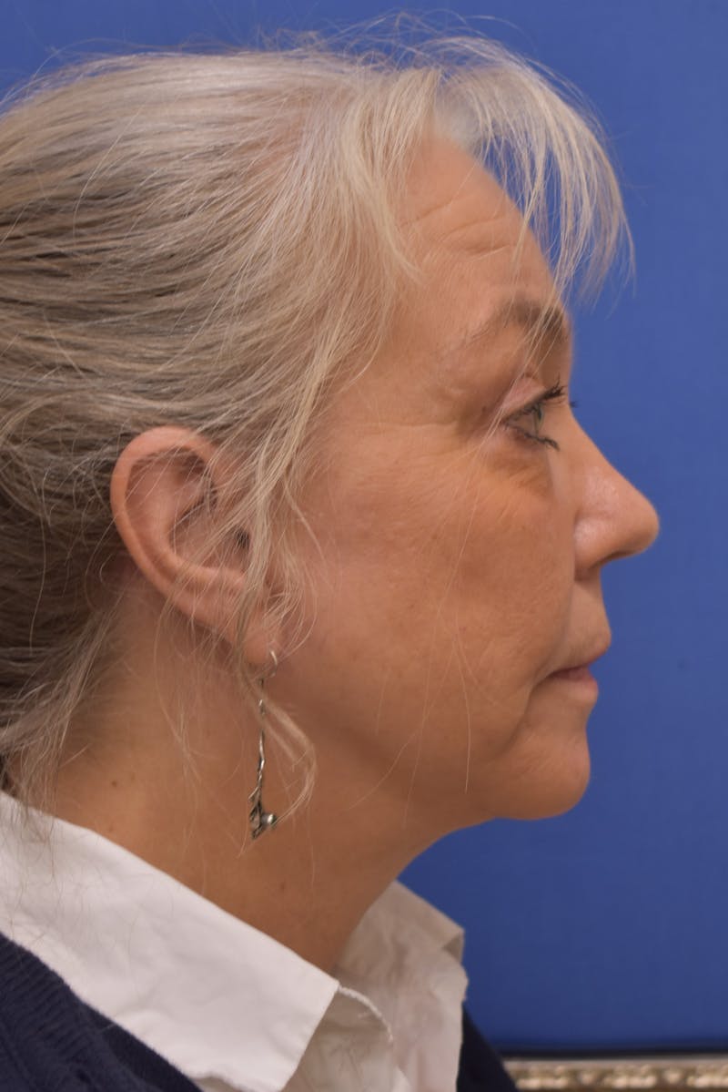 Facelift Before & After Gallery - Patient 218514 - Image 6