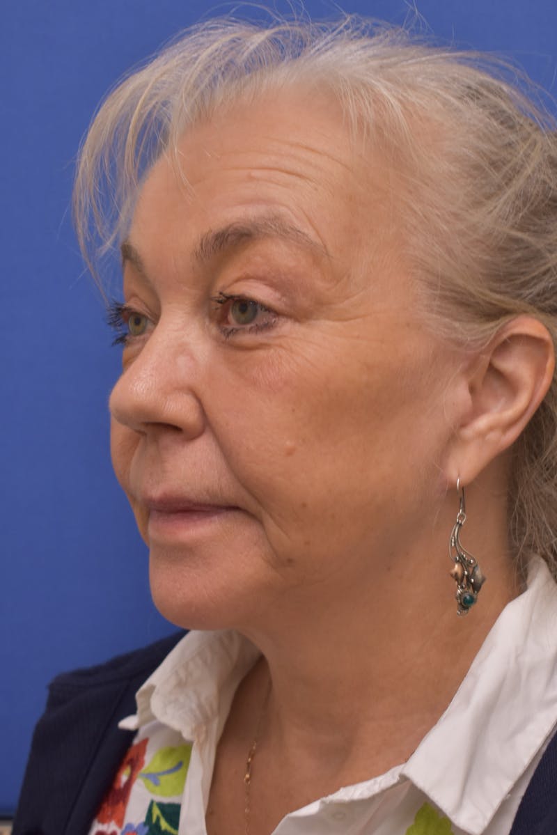 Facelift Before & After Gallery - Patient 218514 - Image 8