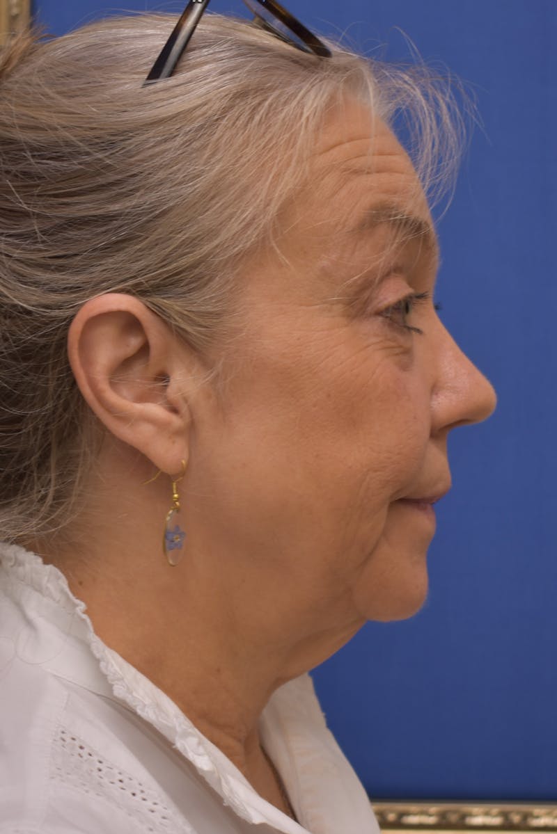 Facelift Before & After Gallery - Patient 218514 - Image 5
