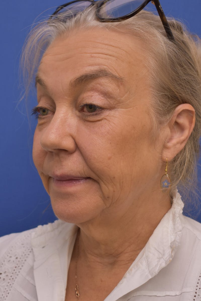 Facelift Before & After Gallery - Patient 218514 - Image 7