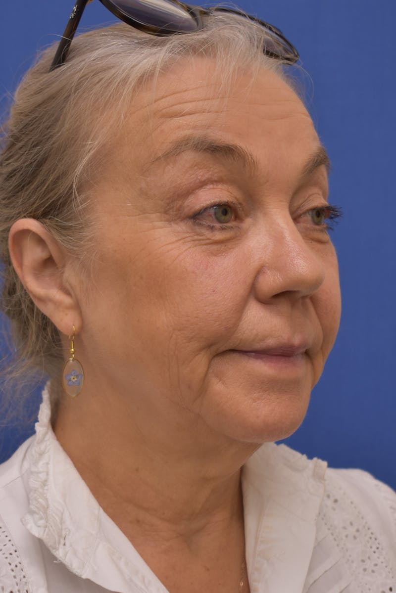 Facelift Before & After Gallery - Patient 218514 - Image 3