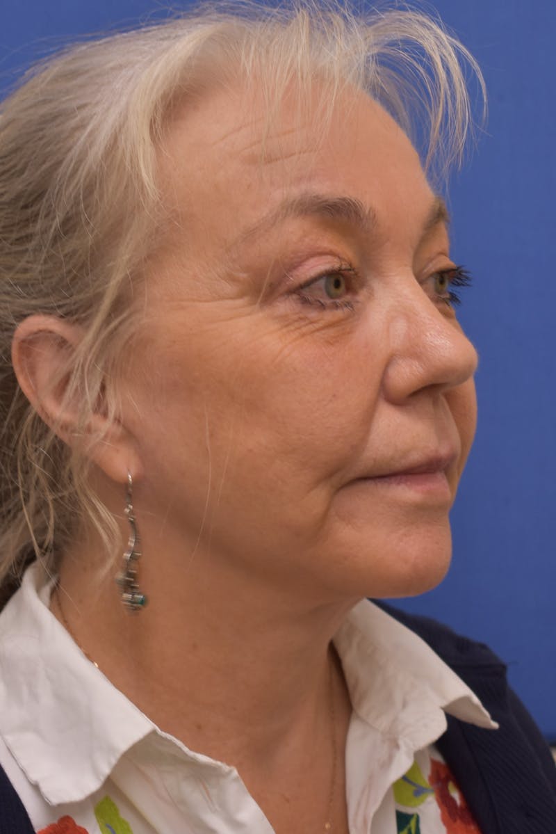 Facelift Before & After Gallery - Patient 218514 - Image 4