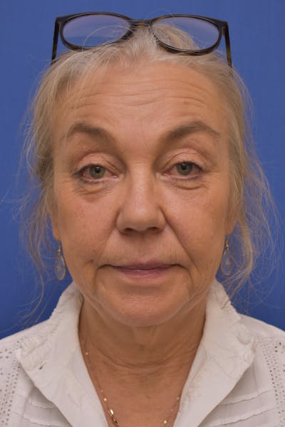 Facelift Before & After Gallery - Patient 218514 - Image 1