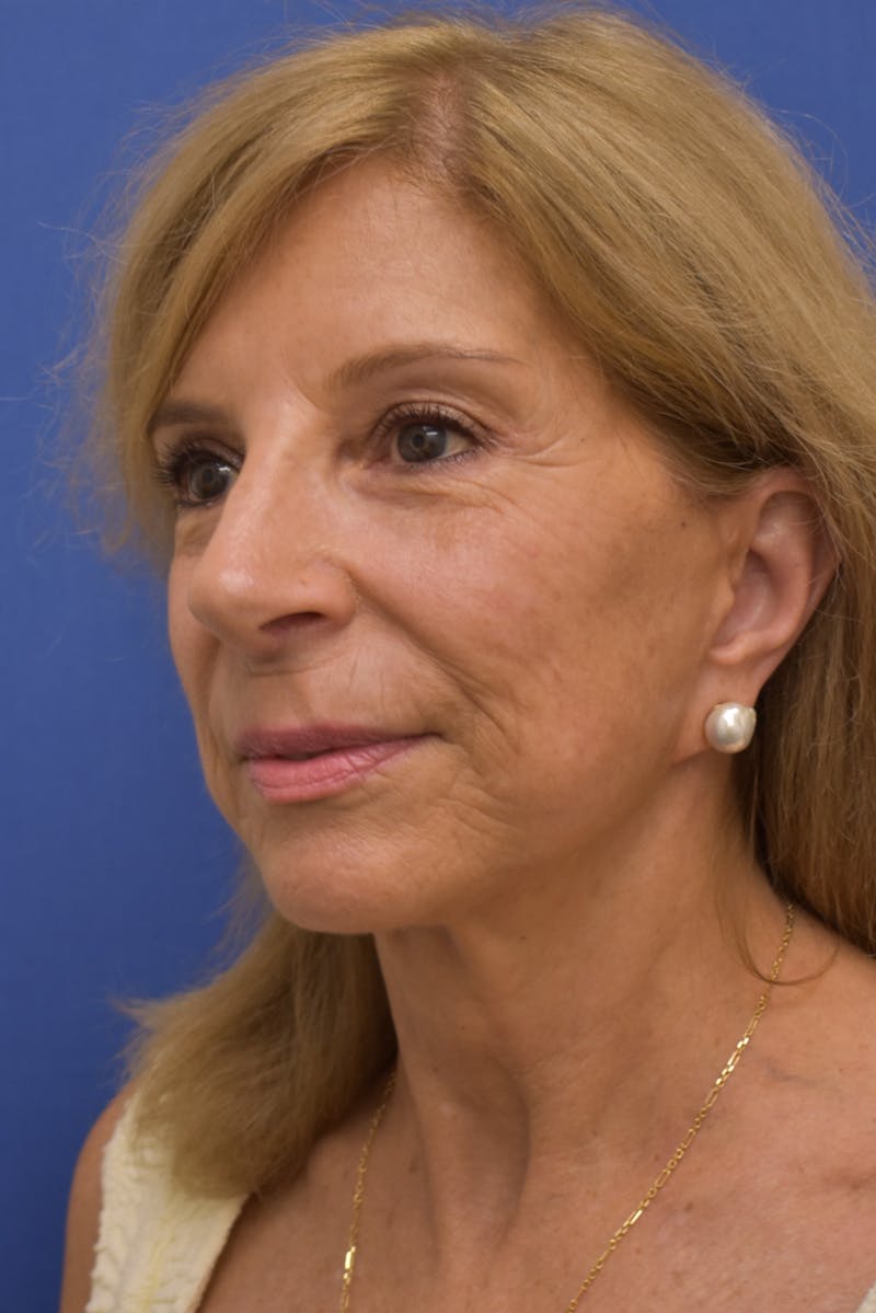 Facelift Before & After Gallery - Patient 402564 - Image 10