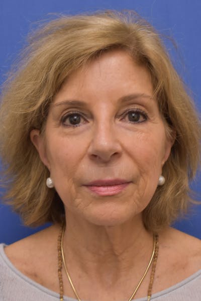 Facelift Before & After Gallery - Patient 402564 - Image 1