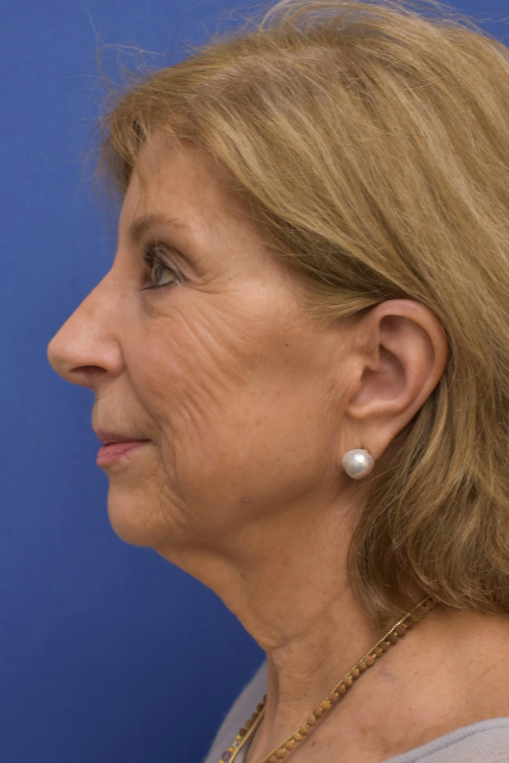 facelift
