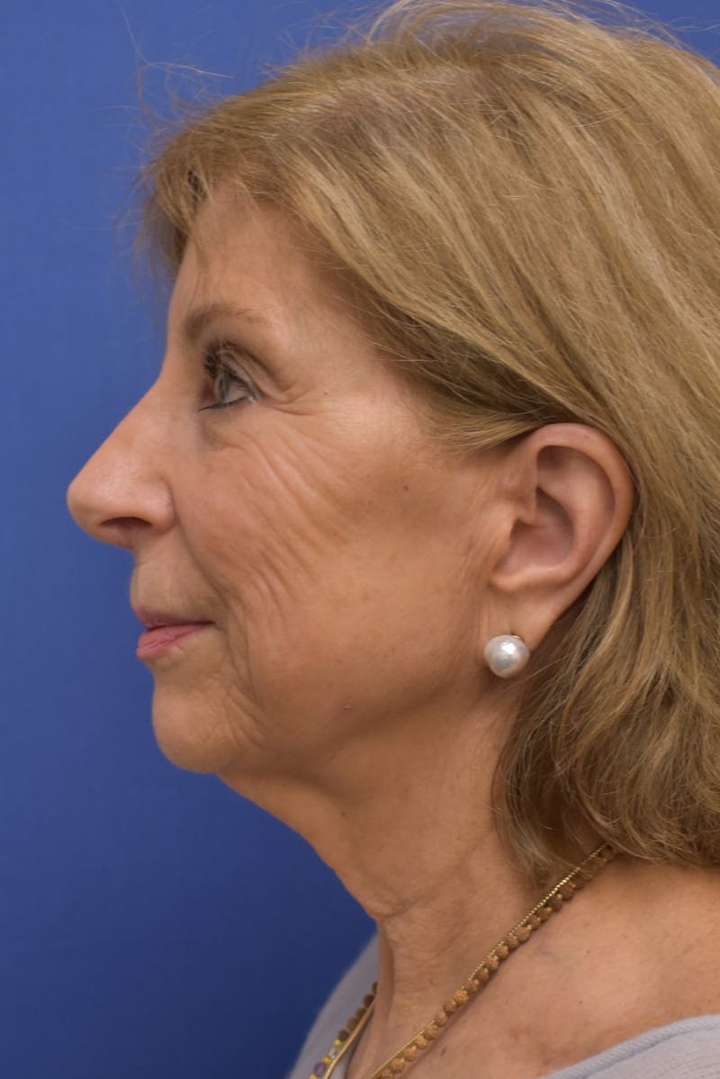 Facelift Before & After Gallery - Patient 402564 - Image 7