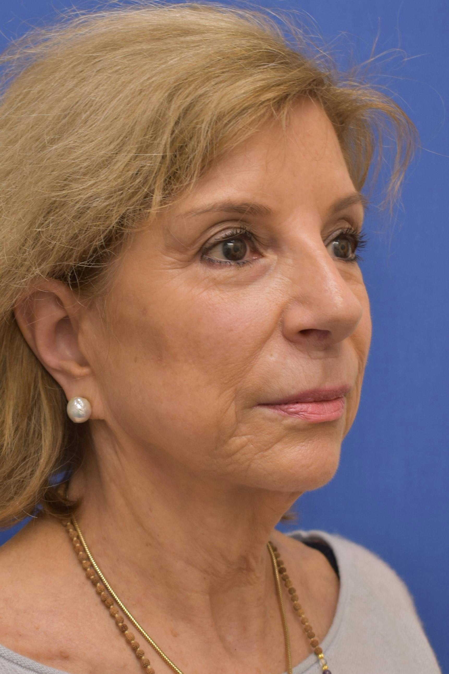 facelift