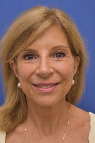 Facelift Before & After Gallery - Patient 402564 - Image 2
