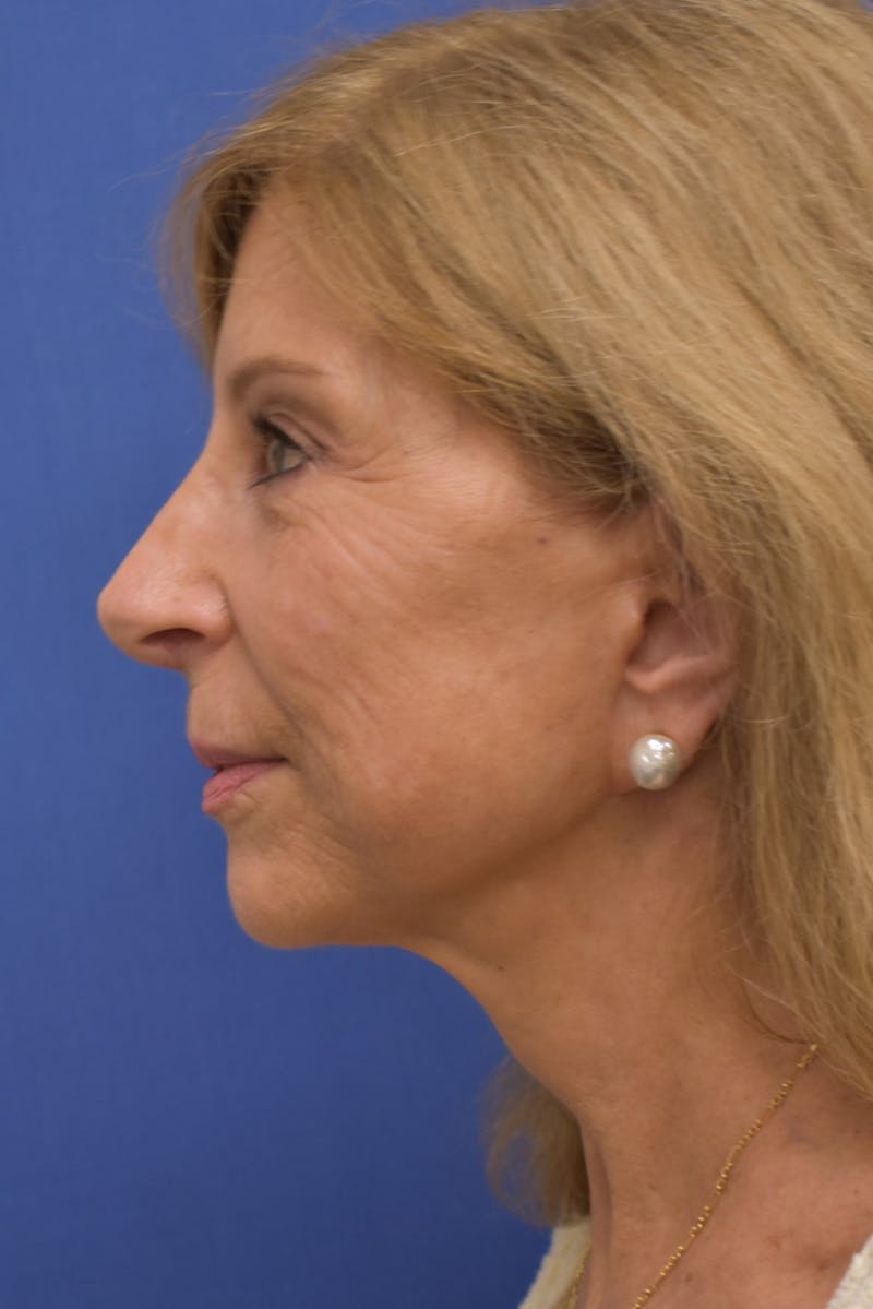 Facelift Before & After Gallery - Patient 402564 - Image 8