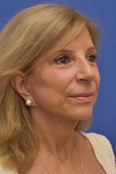 Necklift Before & After Gallery - Patient 102674 - Image 2