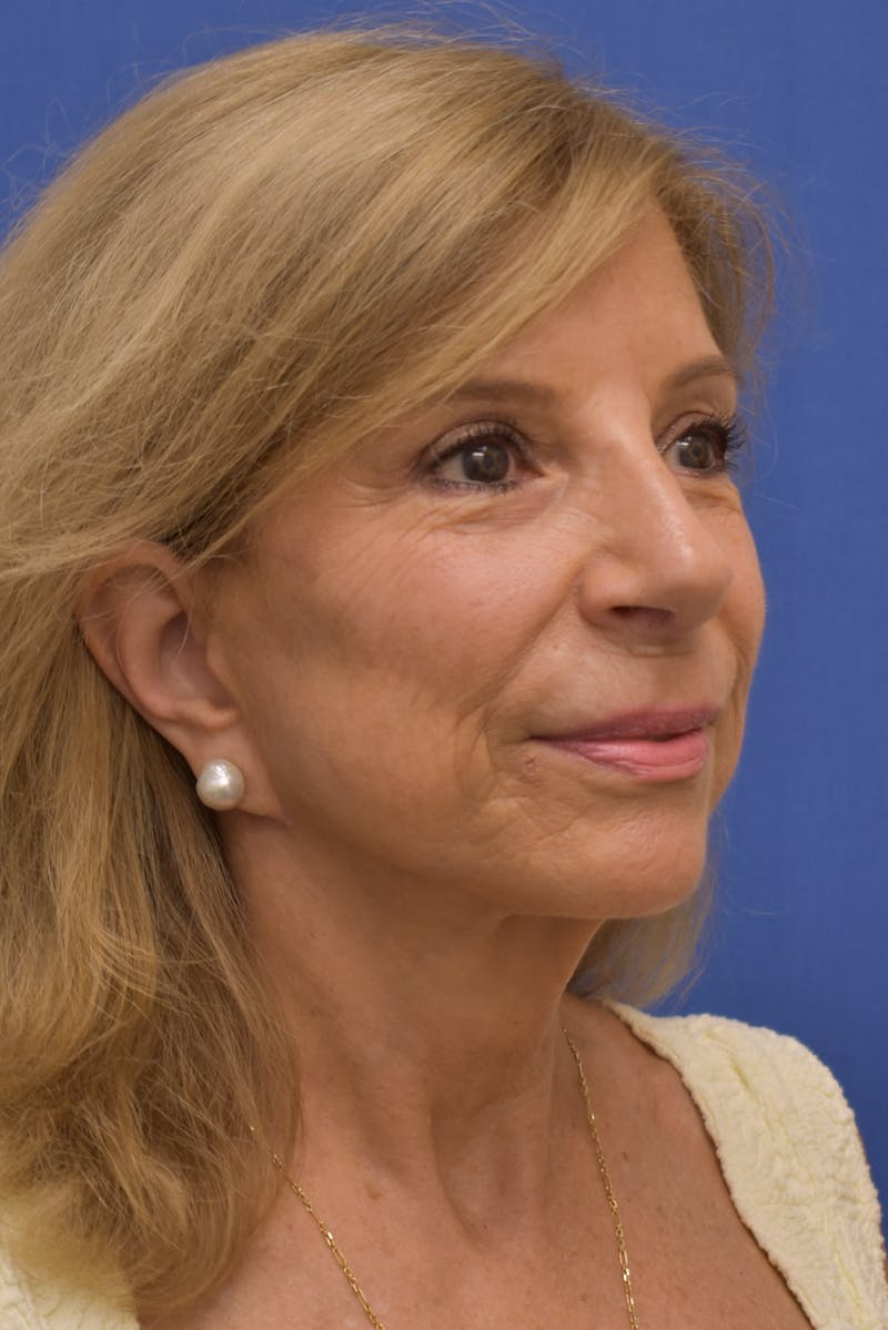 Facelift Before & After Gallery - Patient 402564 - Image 4