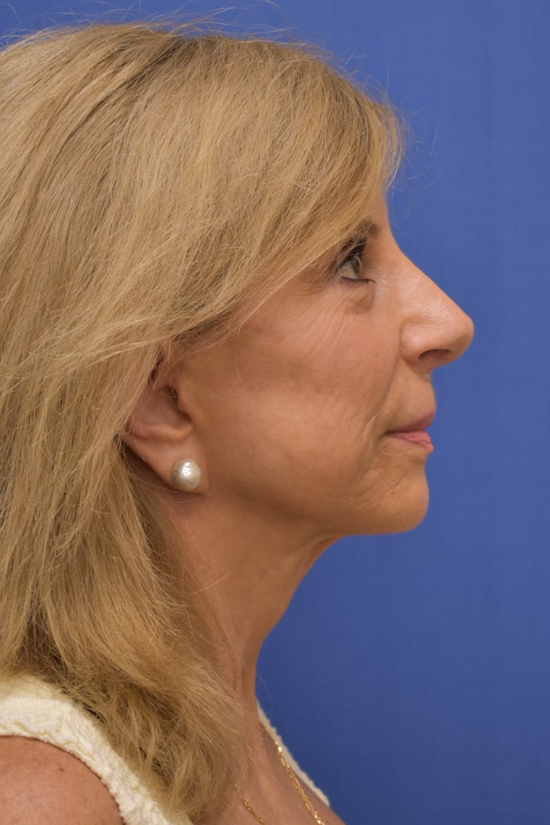 Facelift Before & After Gallery - Patient 402564 - Image 6