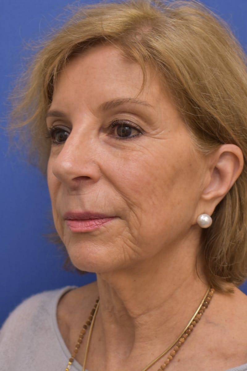 Facelift Before & After Gallery - Patient 402564 - Image 9