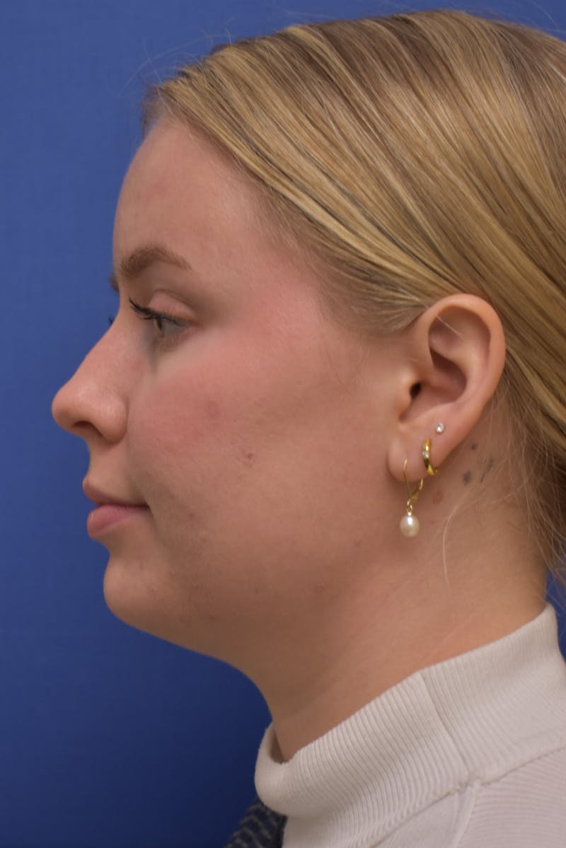 Submental Liposuction Before & After Gallery - Patient 157976 - Image 3