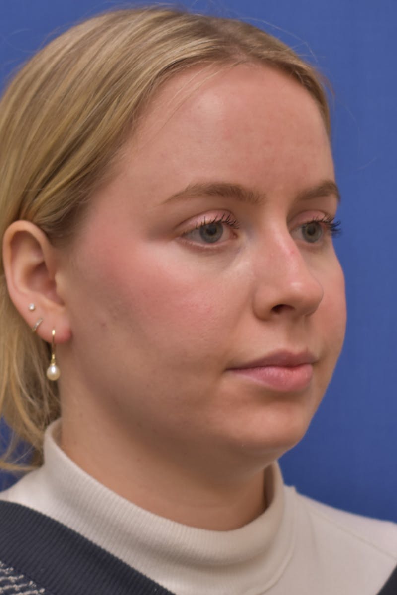 Submental Liposuction Before & After Gallery - Patient 157976 - Image 5