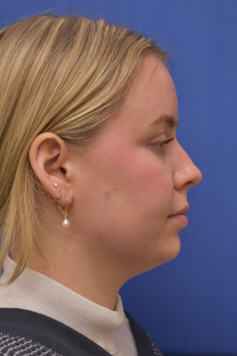 Submental Liposuction Before & After Gallery - Patient 157976 - Image 7