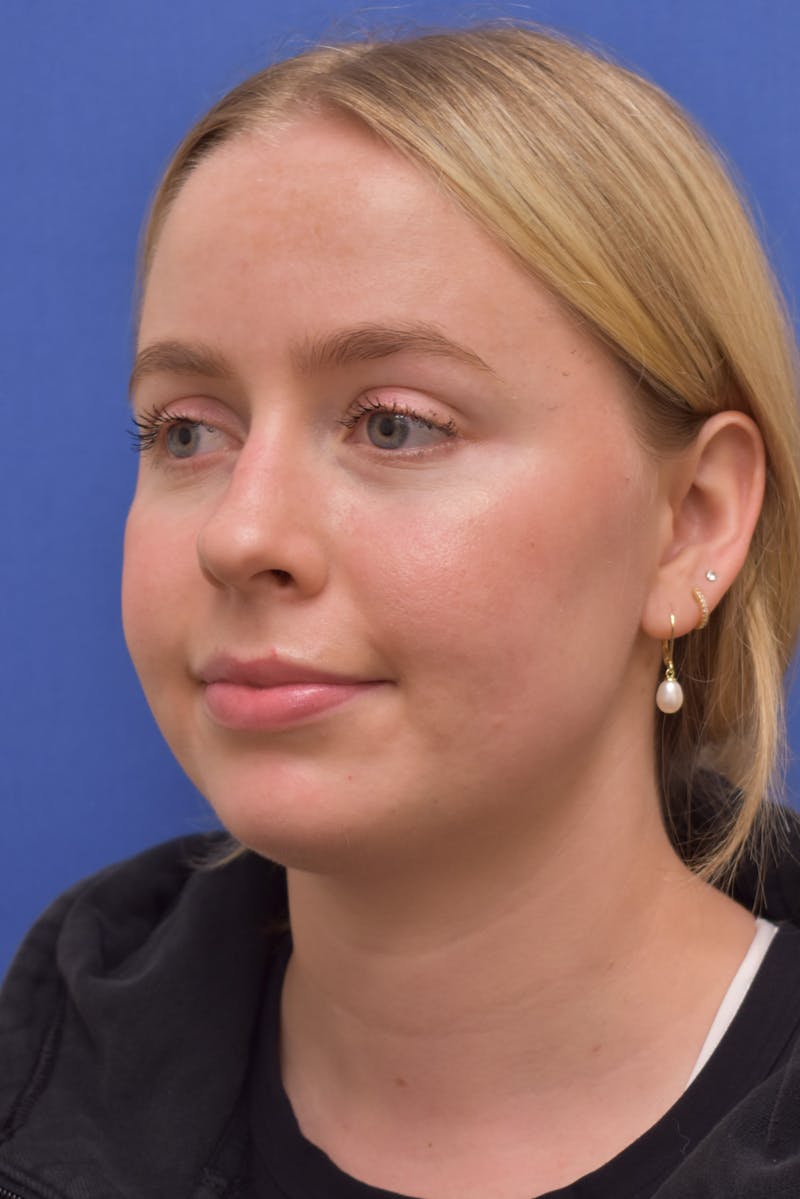 Submental Liposuction Before & After Gallery - Patient 157976 - Image 2