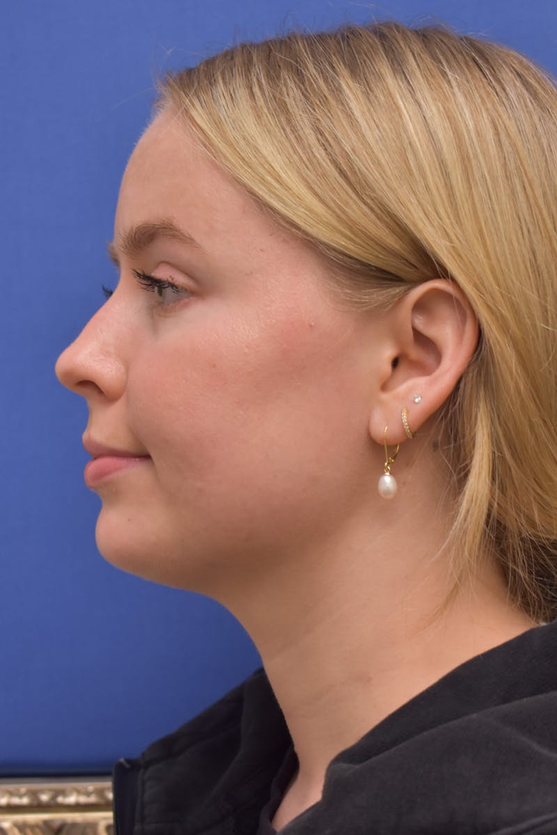 Submental Liposuction Before & After Gallery - Patient 157976 - Image 4