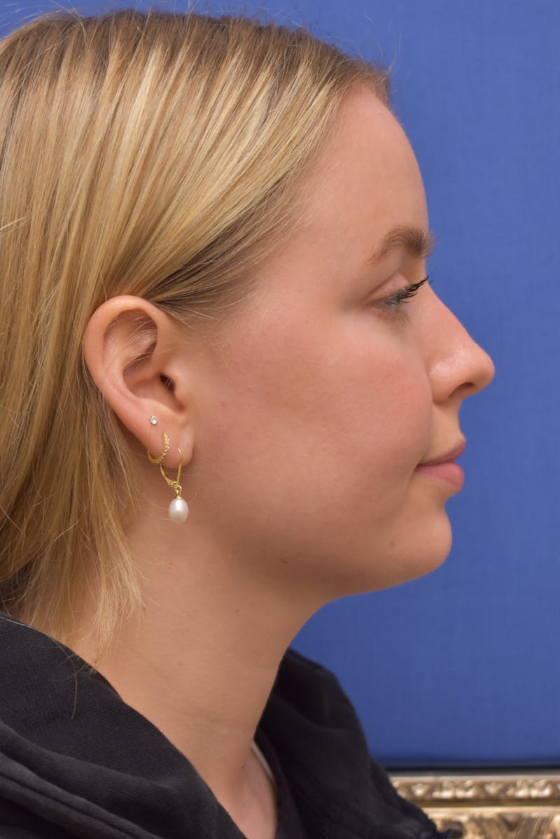 Submental Liposuction Before & After Gallery - Patient 157976 - Image 8