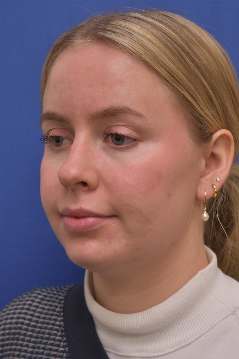 Submental Liposuction Before & After Gallery - Patient 157976 - Image 1