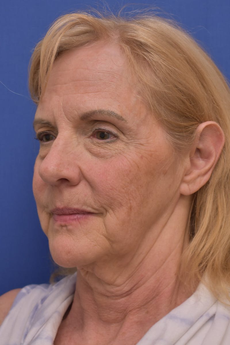 Facelift Before & After Gallery - Patient 241237 - Image 3